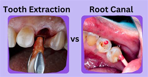 removing tooth root from gum